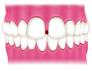 前歯の隙間（すきっ歯）